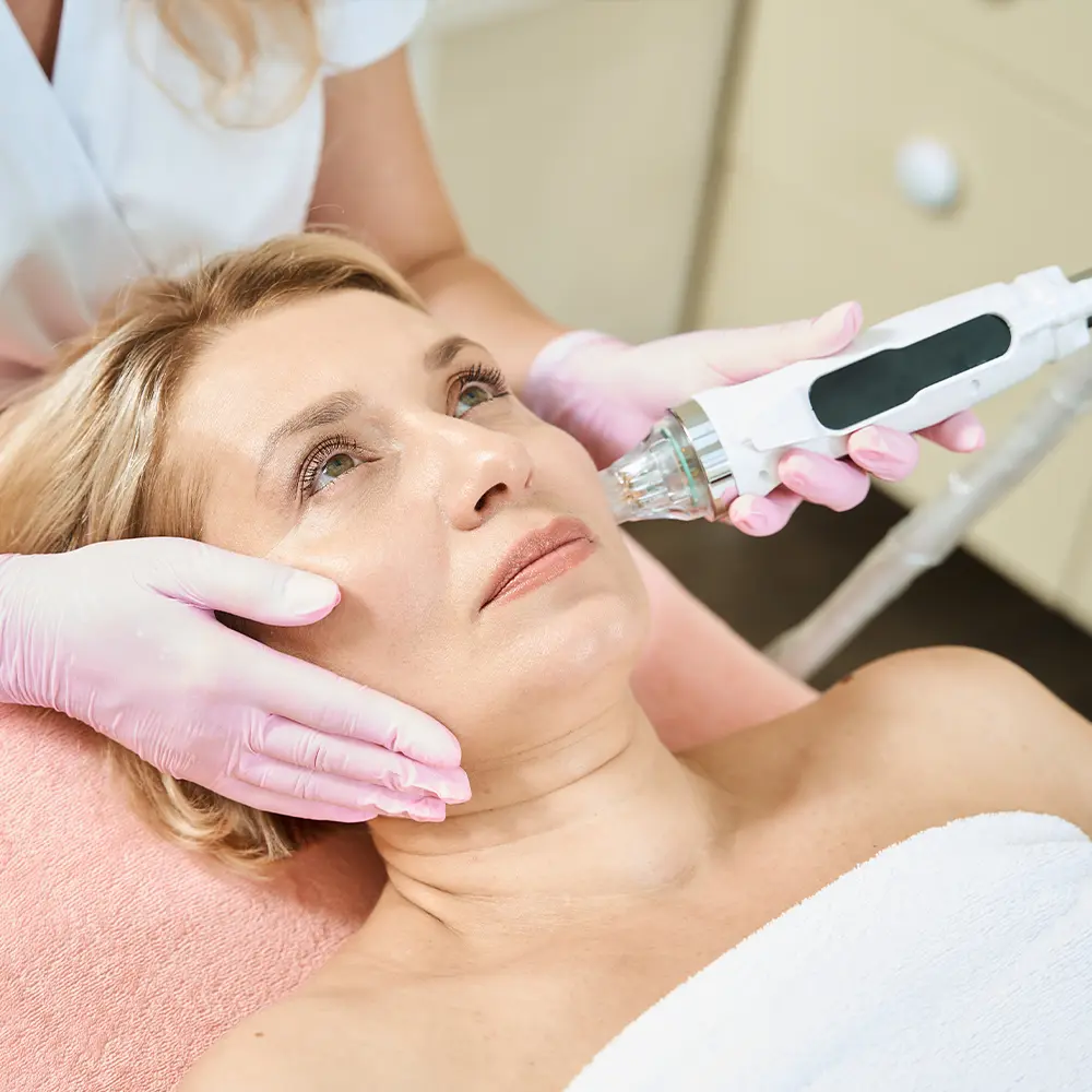 Microneedling skin treatment Carlisle
